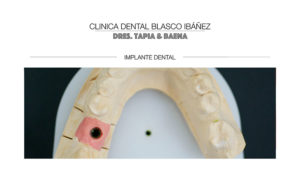 Implantes dentales Madrid