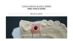 Implantes dentales Sanchinarro