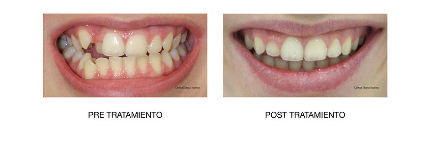 Ortodoncia post tratamiento