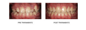 Ortodoncia post tratamiento Madrid